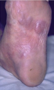 Fibroide Knoten an der Fußsohle derselben Patientin 