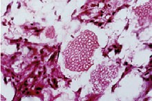 Abb. 3: Sphaerula-Struktur der Kokzidioiden in der Histologie