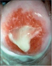 Abb. 1 Purulente Zervizitis in der Kolposkopie.  Die Patientin hatte zusätzlich eine Urethritis,  und Leukozyten +++  im vaginalen Abstrich.  Selbst solche Infektionen der Zervix können  asymptomatisch  verlaufen, da die Cervix  uteri wenig innerviert  ist (mit freundlicher  Genehmigung von Prof.  Dr. Michael Runge).