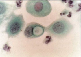 Abb. 2  PapanicolauAbstrich mit  Nachweis von  intrazellulären  Retikulozyten  in zervikalem  Epithel bei Chlamydien-Infektion  (mit freundlicher  Genehmigung  von Prof. Dr.  Michael Runge).
