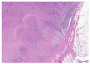 Abb. 3 Granulomatöse nekrotisierende Lympha- denitis (Hämatoxylin und Eosin, 4x)