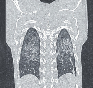 Abb. 1 Pneumocystis jirovecii-Pneumonie im CT-Thorax