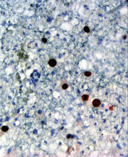 Abb. 1  Immunhistochemischer Nachweis von JC-Virusprotein (braun angefärbt) in einer Hirn-biopsie bei PML © wikimedia.org, Marvin 101, Auswahl andmore-Media