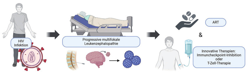 Abb. 2  Innovative Therapieverfahren bei der PML (Created in BioRender. Grote-levi, L. (2025) https://BioRender.com/b21s047)