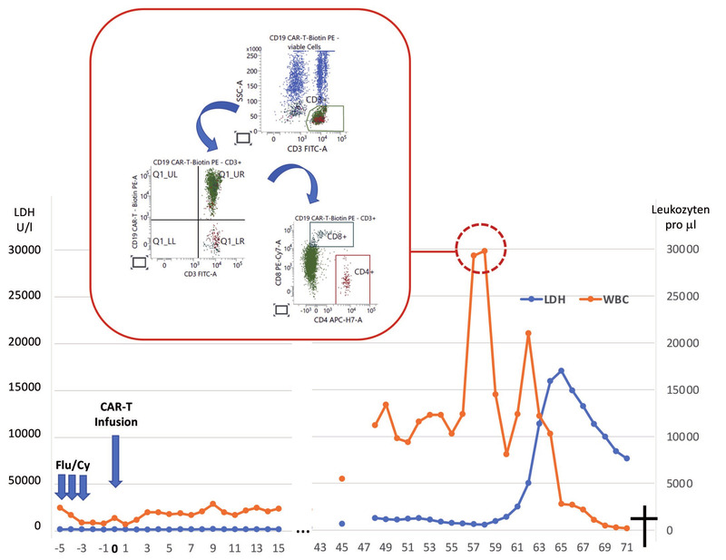 Abb. 2   Klinischer Verlauf eines Patienten mit sekundärem CAR+ T-Zell Lymphom (Kobbe, NEJM 2024). Etwa  50 Tage nach der CAR-T-Zelltherapie kam es zu einer massiven Expansion CD4-CD8-klonaler T-Zellen, die über eine HLH und DIC trotz Therapie zum Tod des Patienten führten