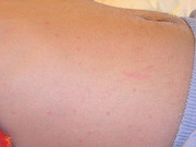 Abb. 1   Roseolen auf der Bauchhaut eines Patienten mit Typhus abdominalis