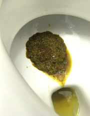 Abb. 3   Klassische Erbsbrei-Diarrhoe bei Typhus
