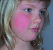 Abb. 2 Erythem der Wangen bei einem Kind mit Ringelröteln