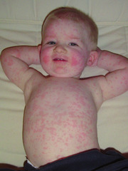 Abb. 3 Hautausschlag bei Ringelröteln