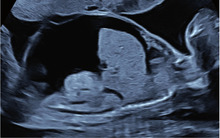 Abb. 4 Sonographischer Befund eines Feten in SSW 19 mit B19V-bedingtem Hydrops fetalis (mit freundlicher Genehmigung von Prof. Dr. med. Karl Oliver Kagan, Universitätsfrauenklinik Tübingen)