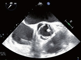 Abb. 1 Aortenklappe ohne flottierende Vege- tation. Unspezifische, rundliche Verdickung des Klappenrandes