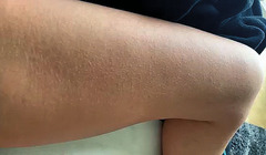 Abb. 2   Makulopapulöses Exanthem bei akutem Chikungunya-Fieber