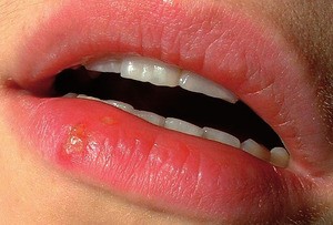 Herpes labialis mit zwei geöffneten und einem noch geschlossenen Bläschen © wikipedia.org
