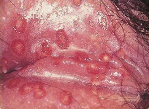 Herpes genitalis Vulva