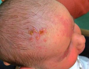 Kutane Form Herpes neonatorum © commons.wikimedia.org/wiki/