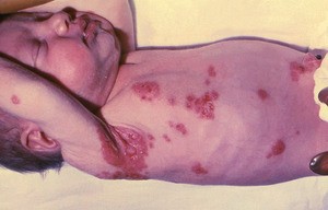 Herpes neonatorum . 12 Stunden alter Säugling mit HSV-1 Infektion © Public Health Image Library CDC