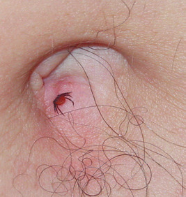 Zeckenstich von Weibchen im Bauchnabel